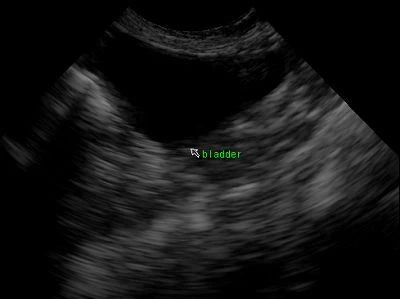 bladder