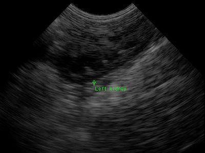 Left kidney2